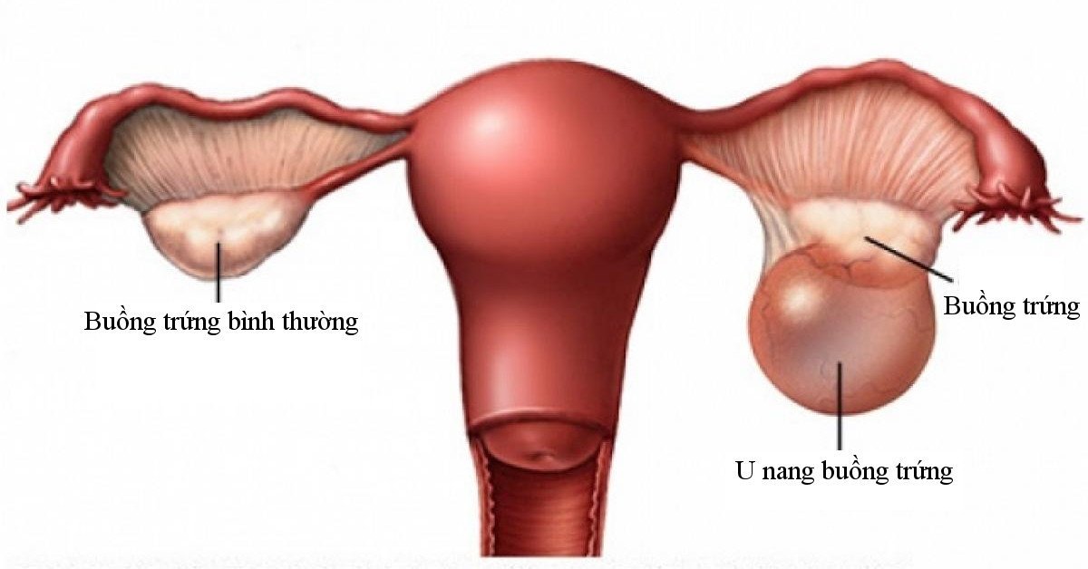 Nhận diện 4 dấu hiệu u nang buồng trứng thường gặp ở phụ nữ