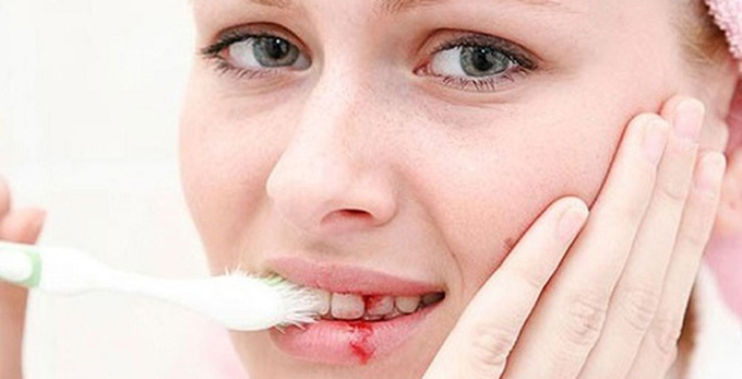 Nướu răng bị chảy máu là bệnh gì?