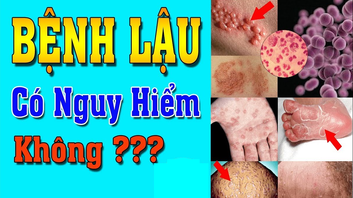 Bệnh lậu có nguy hiểm không?