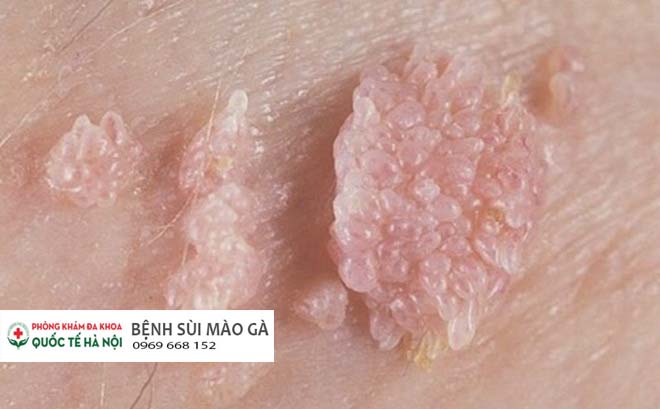 Bệnh mồng gà là gì? Nguyên nhân, Biểu hiện & Điều trị