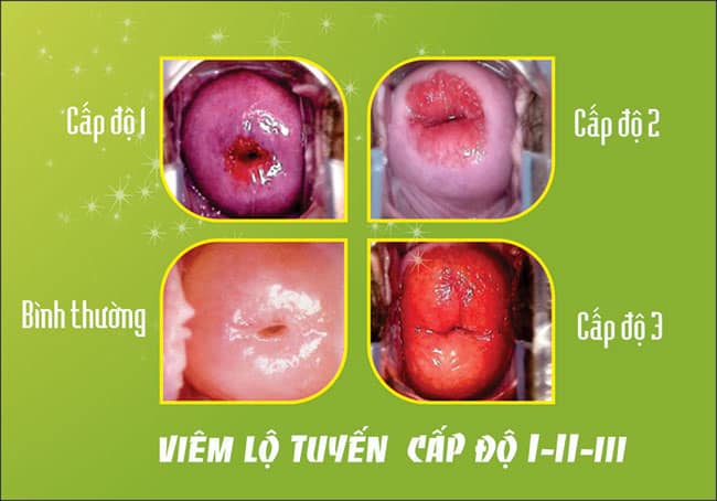 Các cấp độ viêm lộ tuyến cổ tử cung