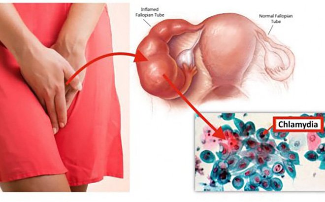 Chlamydia là bệnh gì?
