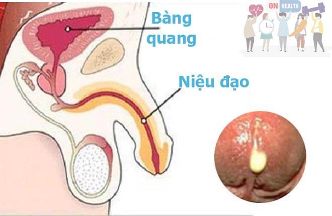 Tiểu ra mủ là bệnh gì?