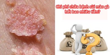 Chi phí chữa sùi mào gà hết bao nhiêu tiền?