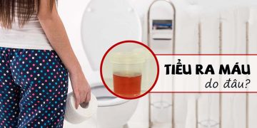 Tiểu buốt ra máu: Nguyên nhân và cách điều trị
