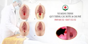 Vá màng trinh bao nhiêu tiền? có đau không?