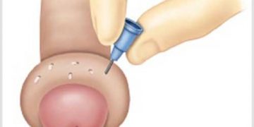 Cắt bao quy đầu bị mọng nước, có sao không?