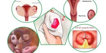 17 nguyên nhân gây chảy máu vùng kín bất thường ở nữ giới