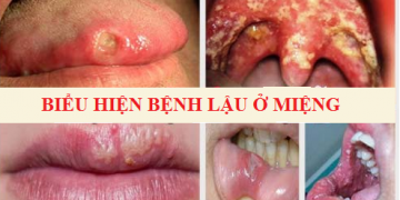 Bệnh lậu ở miệng: Nguyên nhân, triệu chứng và cách chữa